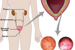 Болит мочевой пузырь Болит мочевой пузырь