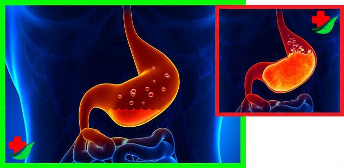 Вздутие живота: причины и способы лечения Вздутие живота: причины и способы лечения