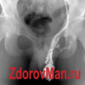 Какие существуют операции при варикоцеле Какие существуют операции при варикоцеле