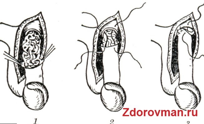 Какие существуют операции при варикоцеле Какие существуют операции при варикоцеле