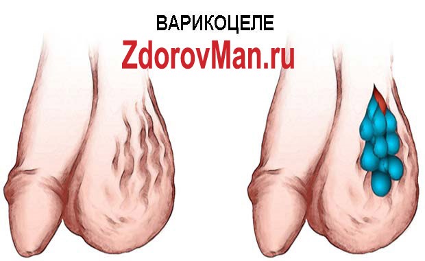 Какие существуют операции при варикоцеле Какие существуют операции при варикоцеле