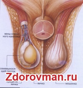 Какие существуют операции при варикоцеле Какие существуют операции при варикоцеле