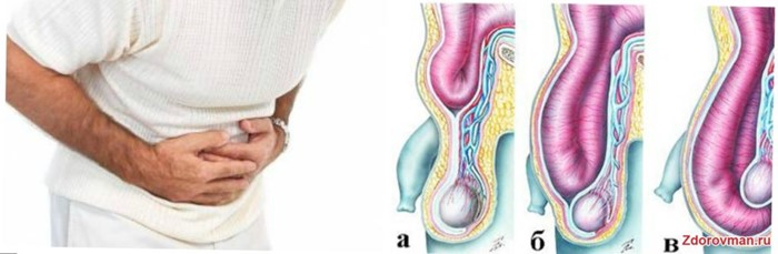 Какие существуют операции при варикоцеле Какие существуют операции при варикоцеле