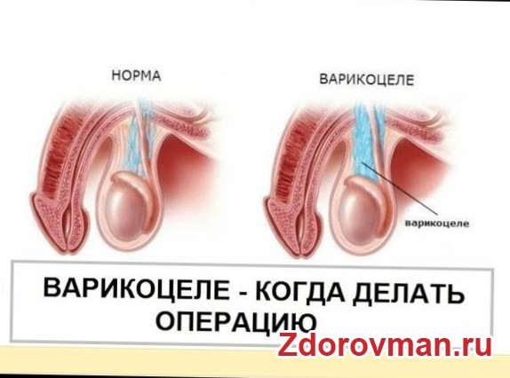 Какие существуют операции при варикоцеле Какие существуют операции при варикоцеле