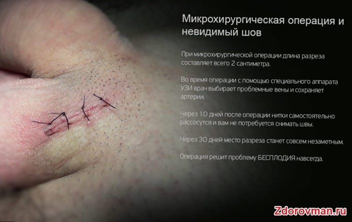 Какие существуют операции при варикоцеле Какие существуют операции при варикоцеле