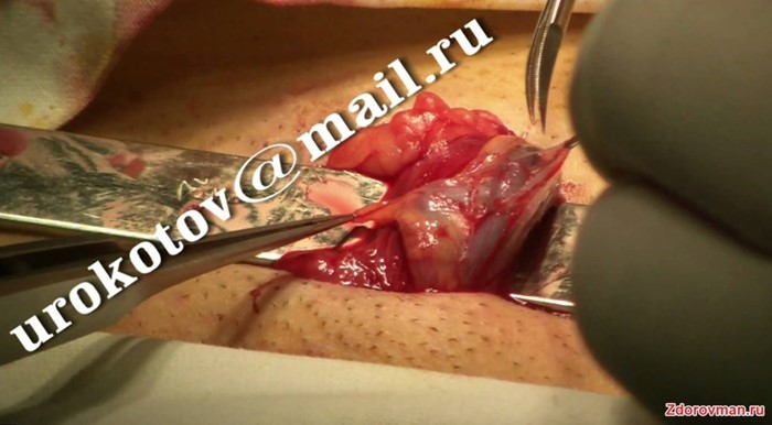 Какие существуют операции при варикоцеле Какие существуют операции при варикоцеле