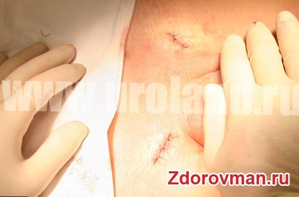 Какие существуют операции при варикоцеле Какие существуют операции при варикоцеле