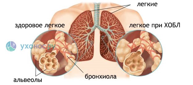 Как и почему возникает ХОБЛ? Как и почему возникает ХОБЛ?
