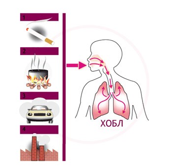 Как и почему возникает ХОБЛ? Как и почему возникает ХОБЛ?