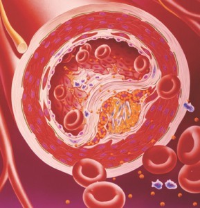 Холестериновые бляшки в сосудах, артериях: лечение, чем опасны Холестериновые бляшки в сосудах, артериях: лечение, чем опасны