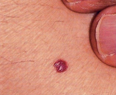 Можно ли вылечить полностью заболевание хронический панкреатит? Можно ли вылечить полностью заболевание хронический панкреатит?