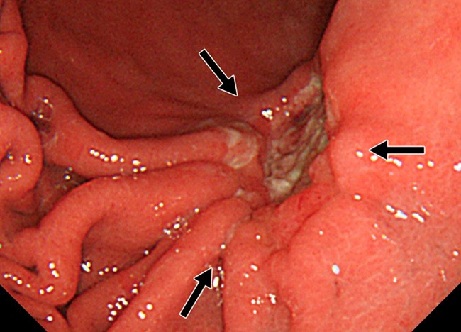Какие симптомы язвы луковицы двенадцатиперстной кишки? Какие симптомы язвы луковицы двенадцатиперстной кишки?