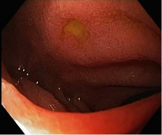 Какие симптомы язвы луковицы двенадцатиперстной кишки? Какие симптомы язвы луковицы двенадцатиперстной кишки?