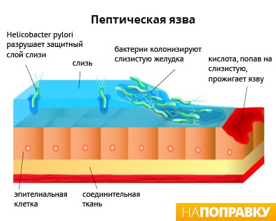 Кровяные язвы в желудке Кровяные язвы в желудке