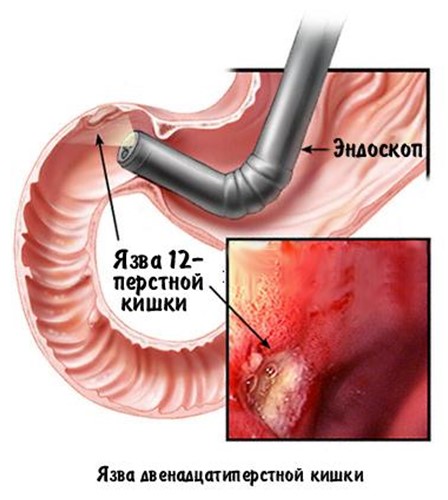 Язва желудка у детей Язва желудка у детей
