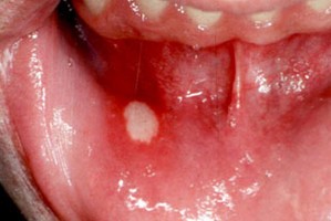 Как избавиться от язвочек в горле Как избавиться от язвочек в горле