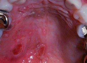 Как избавиться от язвочек в горле Как избавиться от язвочек в горле