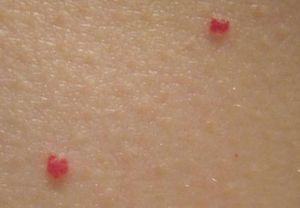 Высыпания на коже при болезни поджелудочной железы Высыпания на коже при болезни поджелудочной железы