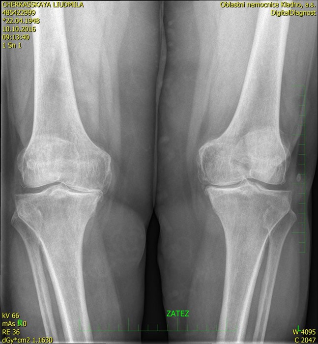 Операция по замене коленного сустава: показания, виды протезов, реабилитация Операция по замене коленного сустава: показания, виды протезов, реабилитация