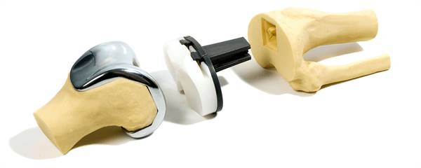 Операция по замене коленного сустава: показания, виды протезов, реабилитация Операция по замене коленного сустава: показания, виды протезов, реабилитация