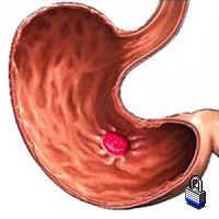 Что делать если появился запор при гастрите? Что делать если появился запор при гастрите?