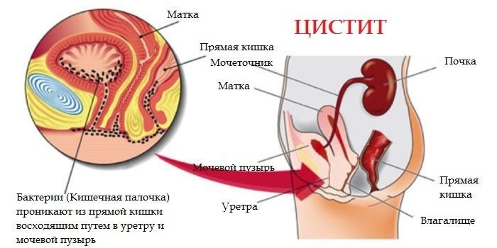 Как передается цистит? Как передается цистит?