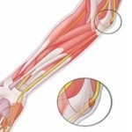Защемление локтевого нерва симптомы Защемление локтевого нерва симптомы