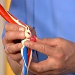 Защемление локтевого нерва симптомы Защемление локтевого нерва симптомы