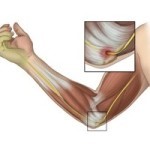 Защемление локтевого нерва симптомы Защемление локтевого нерва симптомы