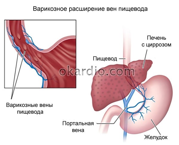 Симптомы и лечение кровотечения в желудке Симптомы и лечение кровотечения в желудке