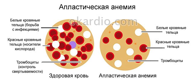 Симптомы и лечение кровотечения в желудке Симптомы и лечение кровотечения в желудке