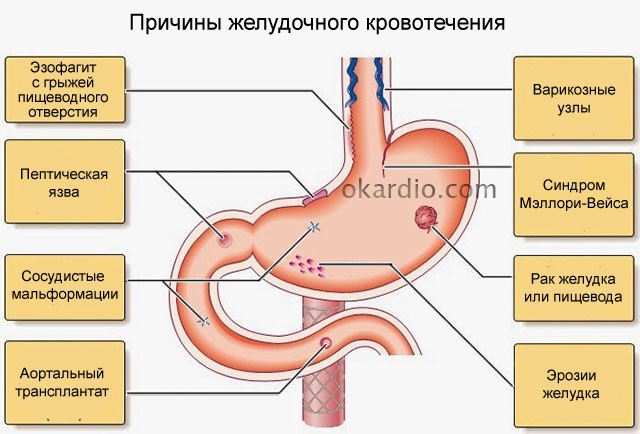 Симптомы и лечение кровотечения в желудке Симптомы и лечение кровотечения в желудке