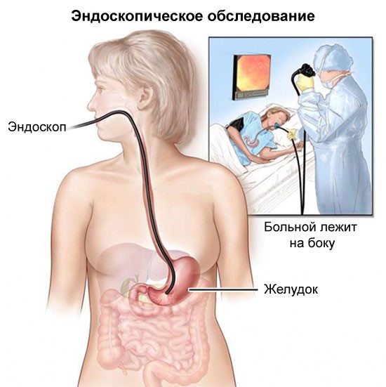 Симптомы и лечение кровотечения в желудке Симптомы и лечение кровотечения в желудке