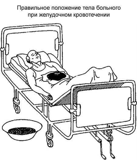 Симптомы и лечение кровотечения в желудке Симптомы и лечение кровотечения в желудке