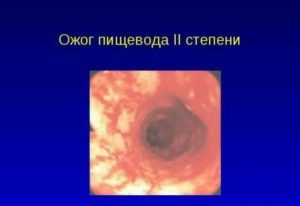 Жжение в горле: причины, симптомы, лечение Жжение в горле: причины, симптомы, лечение