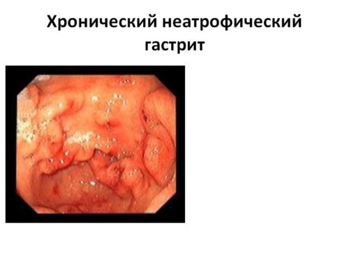 0024-024-KHronicheskij-neatroficheskij-gastrit