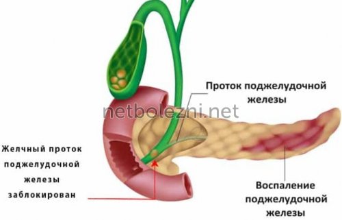 Воспаление поджелудочной железы