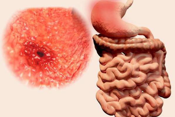 последствия гастрита с повышенной кислотностью