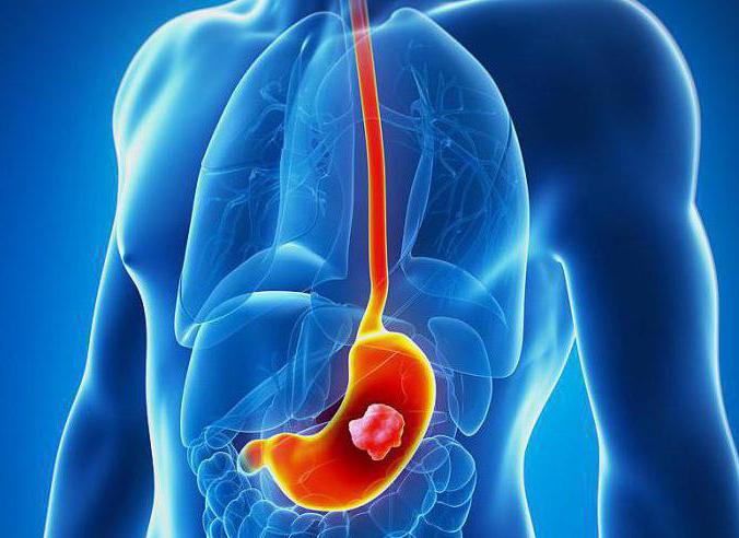 последствия гастрита если не лечить