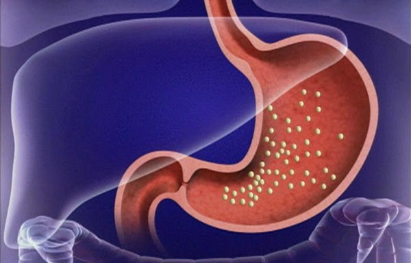 Катаральный гастрит - самая лёгкая форма заболевания, при которой воспалительный процесс поражает только поверхностный слой слизистых тканей желудочных стенок
