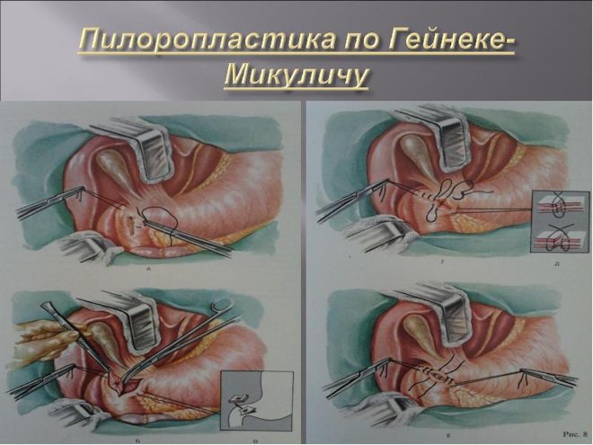 пилоропастика по Гейнеке-Микуличу