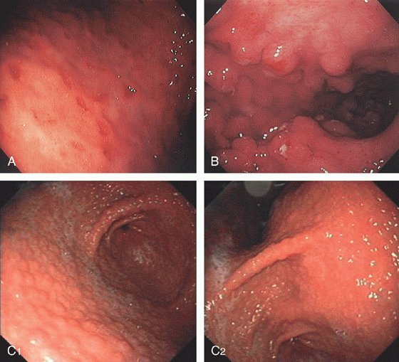 Чем лучше лечить эритематозный гастрит обострение