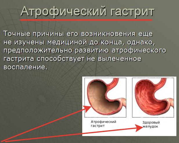 причины возникновения атрофического гастрита у женщин и мужчин