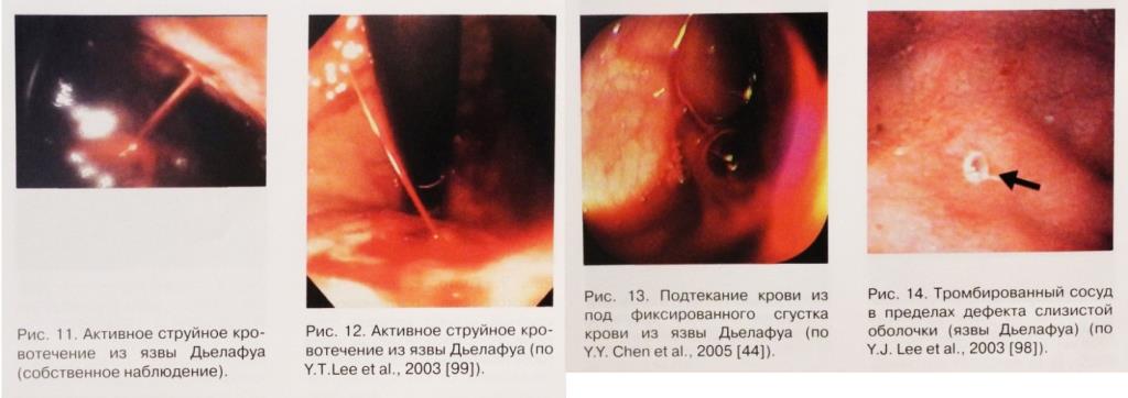 Jet bleeding from an ulcer