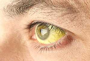 Признак высокого билирубина в крови