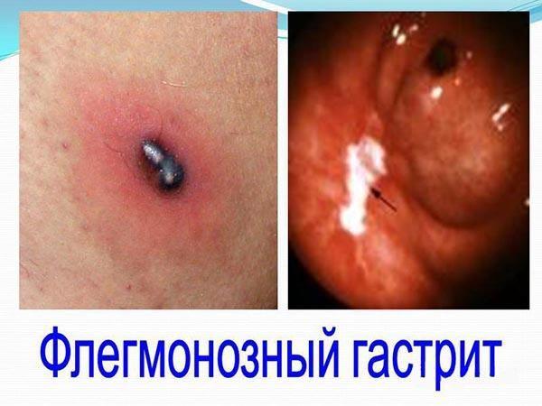 Желудок при флегмонозном гастрите
