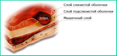 Лечение язвы двенадцатиперстной кишки лекарствами Лечение язвы двенадцатиперстной кишки лекарствами
