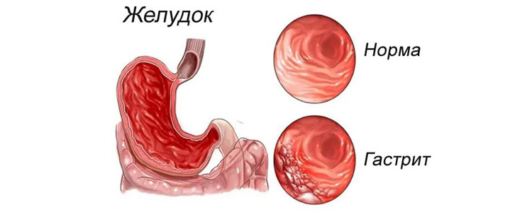Гастрит Гастрит