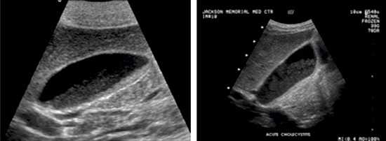 Билиарный сладж на УЗИ