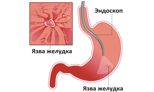 боль в желудке при язве